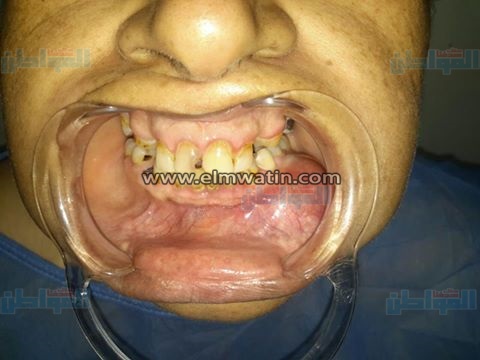 بالصور.. إجراء عملية لإزالة ورم بالفك لأول مرة بمستشفى العامرية