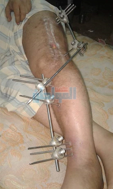 بالصور.. مواطن يستغيث: سيارة دهستني وأصبحت عاجز