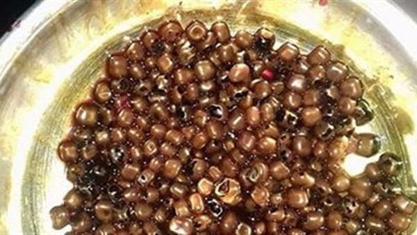 475 حصوة داخل أمعاء