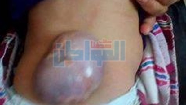أصابة الطفلة