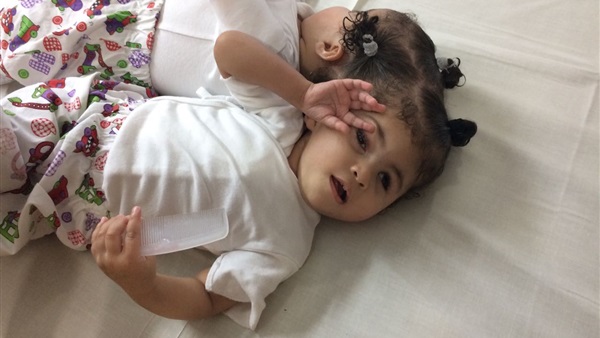 توأم ملتصق